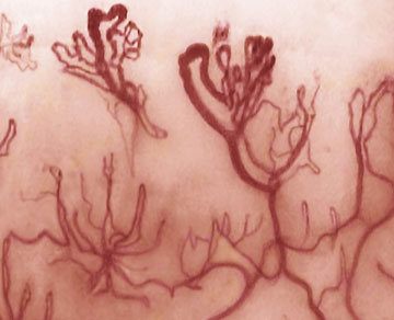 dermoscopia sclerodermia